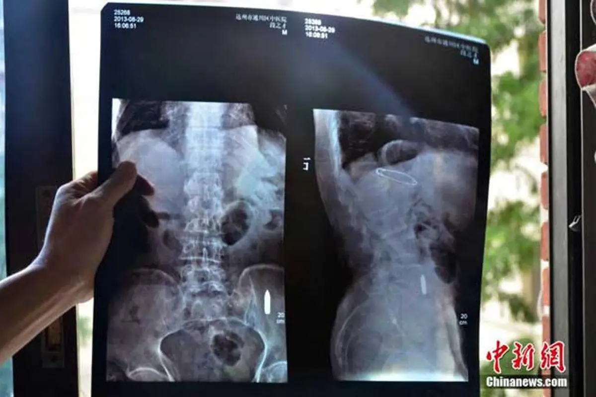 Peluru Bersarang di Tubuh Kakek Ini Selama 60 Tahun