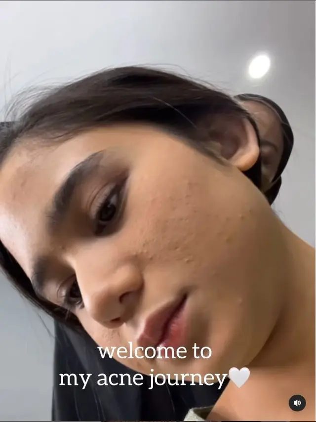 6 Potret Tissa Biani 4 tahun jadi pejuang jerawat, kerap nangis saat bercermin, ajarkan kesabaran