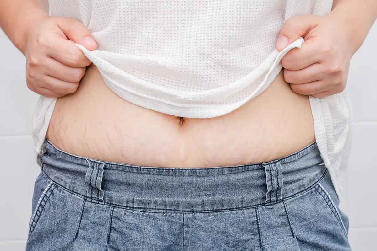 Pemicu Stretch Mark