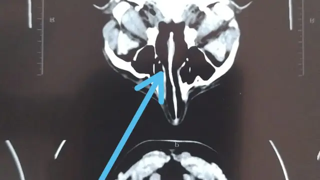 Hasil CT Scan Kepala Claudio Martinez