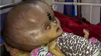 Menderita Hidrosefalus, Bayi Ini Miliki Kepala Terbesar di Dunia
