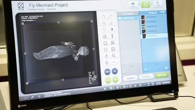 Hasil CT Scan Putri Duyung Fuji