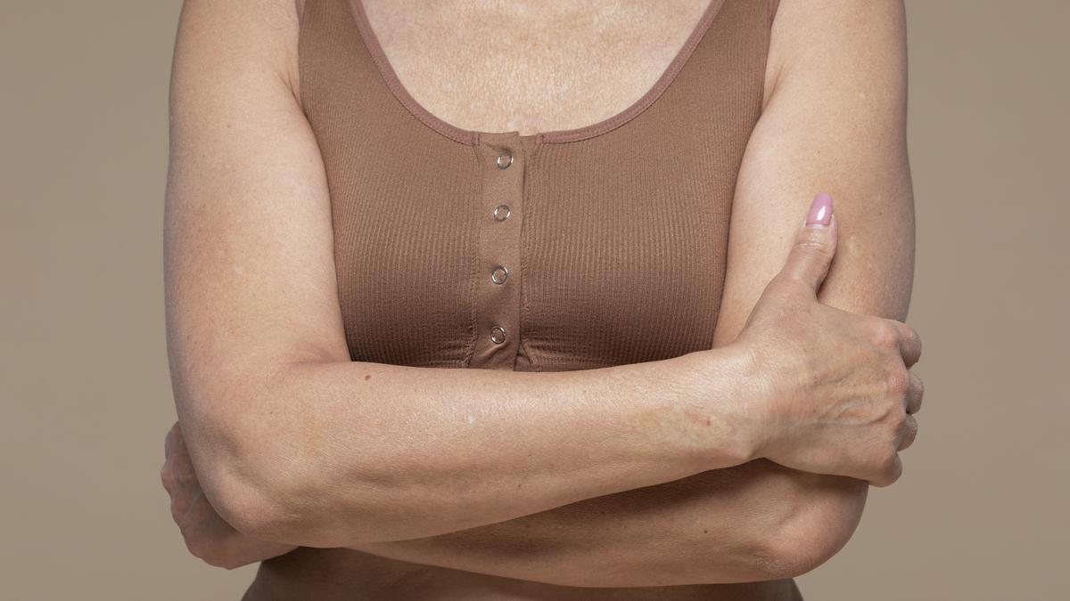 Dokter Ingatkan Pentingnya Merawat Lipatan Tubuh agar Kulit Tetap Sehat