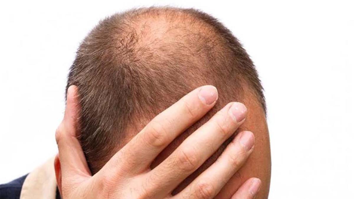 Bahan-Bahan Alami yang Cocok untuk Menebalkan Rambut, Gunakan untuk Mencegah Kebotakan