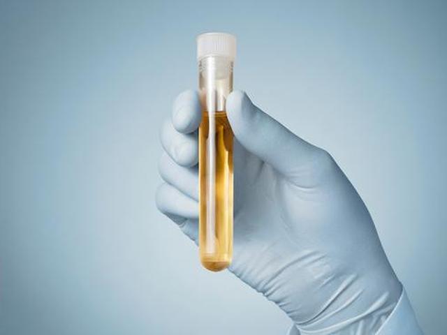 Air Kencing Berbuih Tanda Kelainan Ginjal Health Liputan6 Com