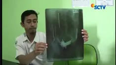 Wawan mengaku telah memakan paku sekitar 6 bulan terakhir dan keluarga menyadari setelah ada paku yang melukai usus.