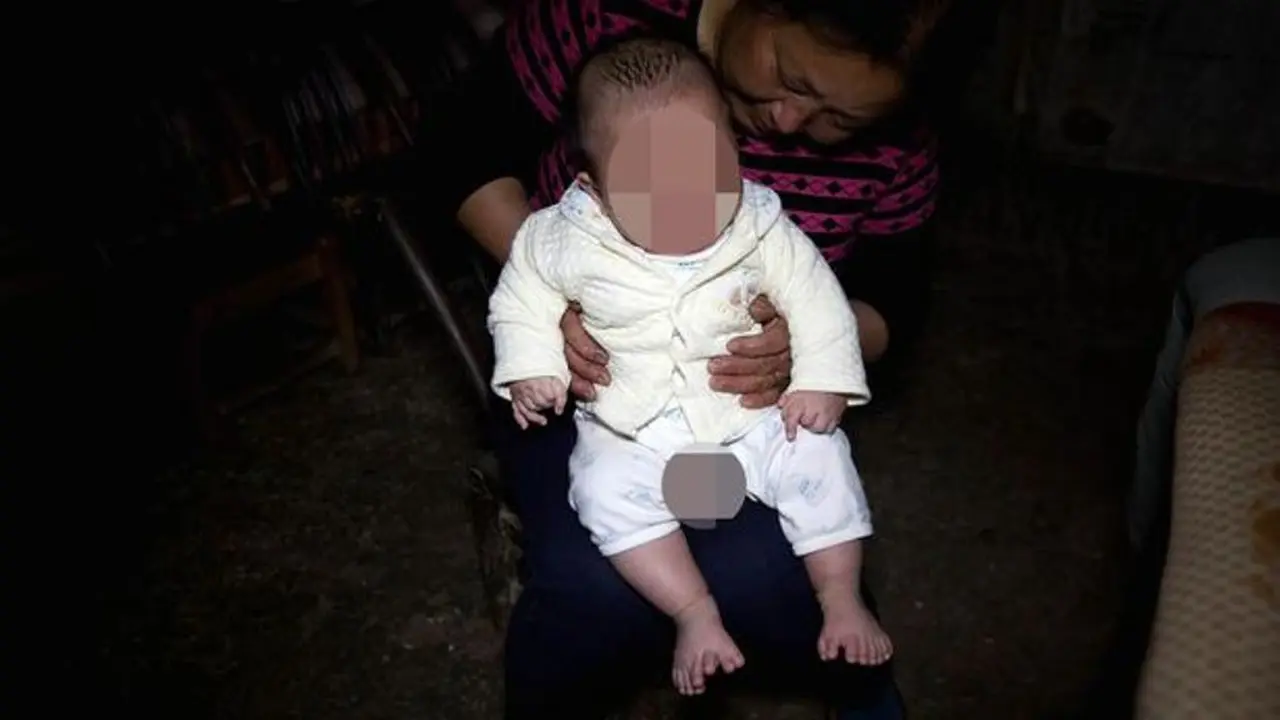 [Bintang] Terlahir 16 Jari, Bayi Ini Jalani Operasi untuk Menguranginya
