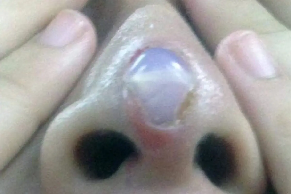 Ingin Tambah Mancung, Implan Silikon di Hidung Wanita Ini Keluar