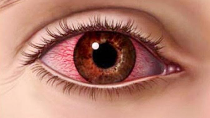 Penyebab Mata Merah & Iritasi