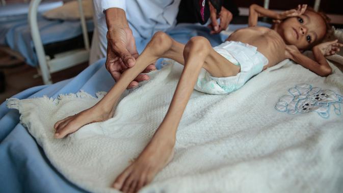 Seorang anak laki-laki penderita gizi buruk berada di tempat tidur rumah sakit di Aslam Health Centre, Hajjah, Yaman (1/11). Malnutrisi, kolera, dan penyakit epidemi lainnya seperti difteri telah menular di daerah tersebut. (AP Photo / Hani Mohammed)