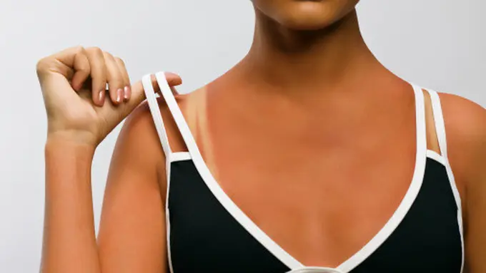 Obat Baru untuk Sunburn