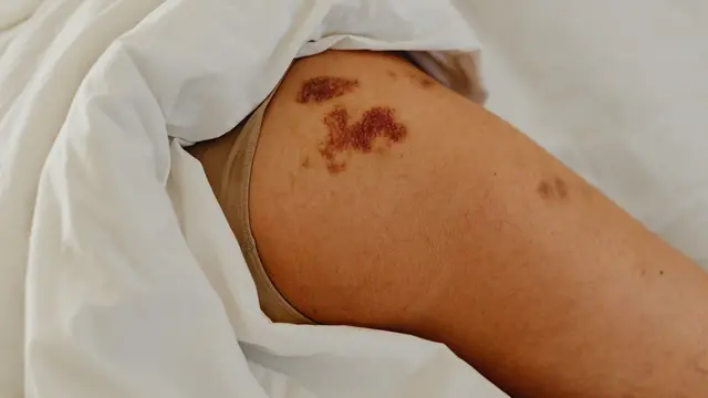 Platelet atau Trombosit