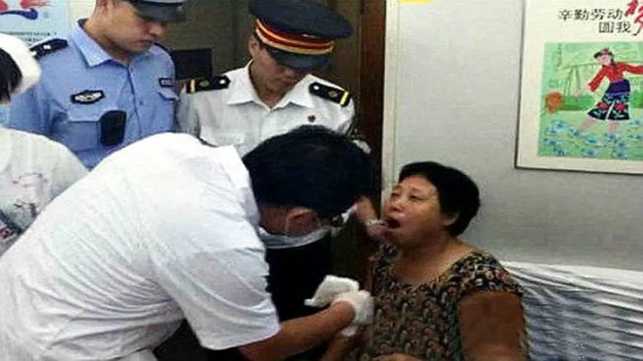 Tertawa Terlalu Lebar, Rahang Wanita Ini Bergeser