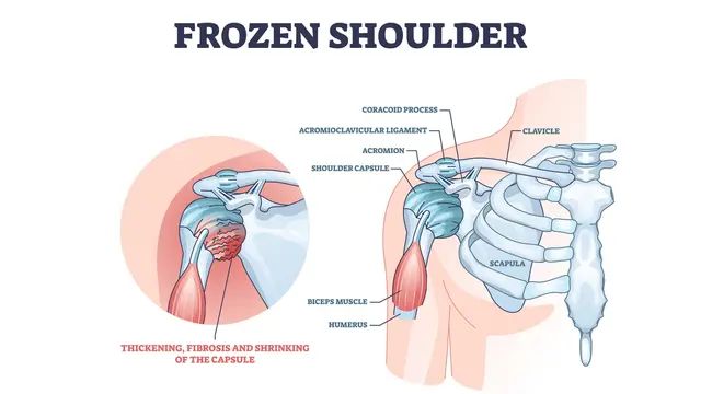 Ilustrasi frozen shoulder, kekakuan pada bahu atau bahu kaku