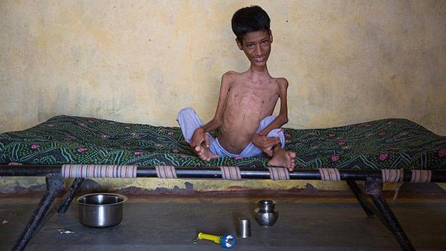  Lihat Dunia Secara Terbalik Selama 12 Tahun, Hidup Mahendra Kini Berubah