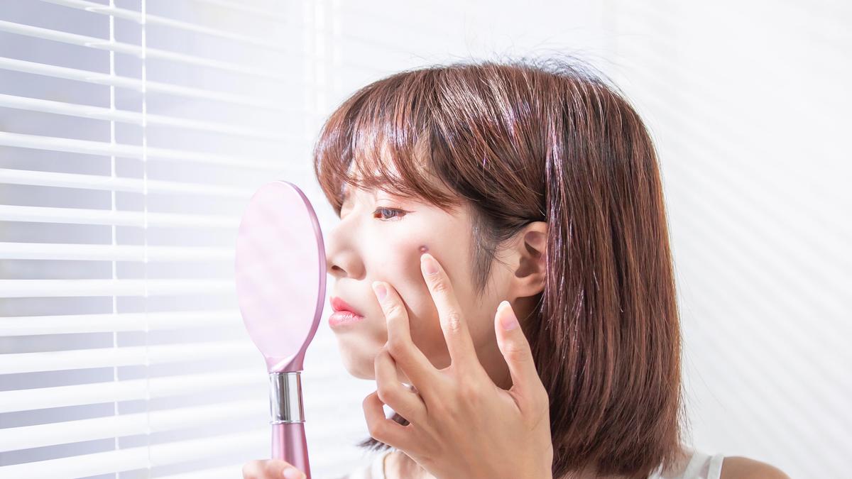 Mau Menggunakan Makeup Saat Wajah Jerawatan? Begini Triknya Biar Kondisinya Nggak Semakin Meradang