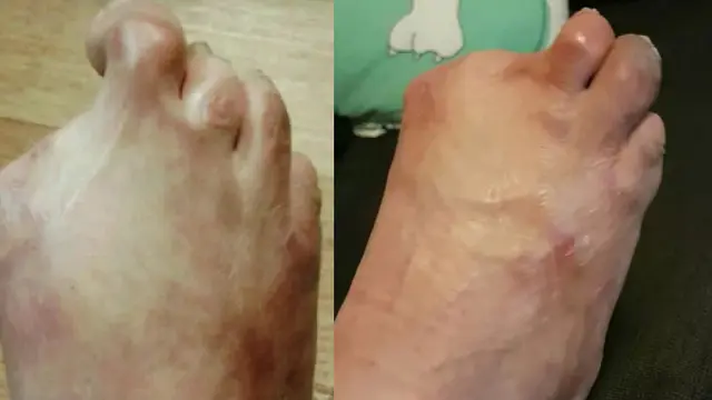 Jari Kaki Wanita ini Diamputasi Setelah Terinfeksi Bakteri dari Spa Ikan