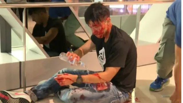Seorang demonstran pro-demokrasi Hong Kong terluka usai gerombolan bersenjata tongkat menyerang massa aksi akhir pekan lalu. Gerombolan itu diduga terafiliasi triad Hong Kong. (AFP PHOTO)