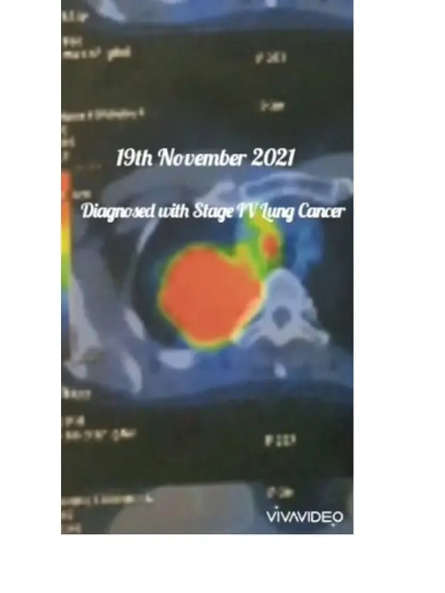 Kiki Fatmala Ungkap Sembuh dari Kanker Paru Stadium 4, Ini 4 Faktanya