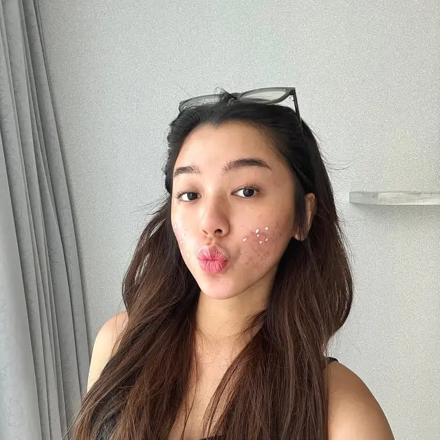 6 Potret Wajah Gabriella Ekaputri Berjerawat, Tetap Percaya Diri Tampil Natural