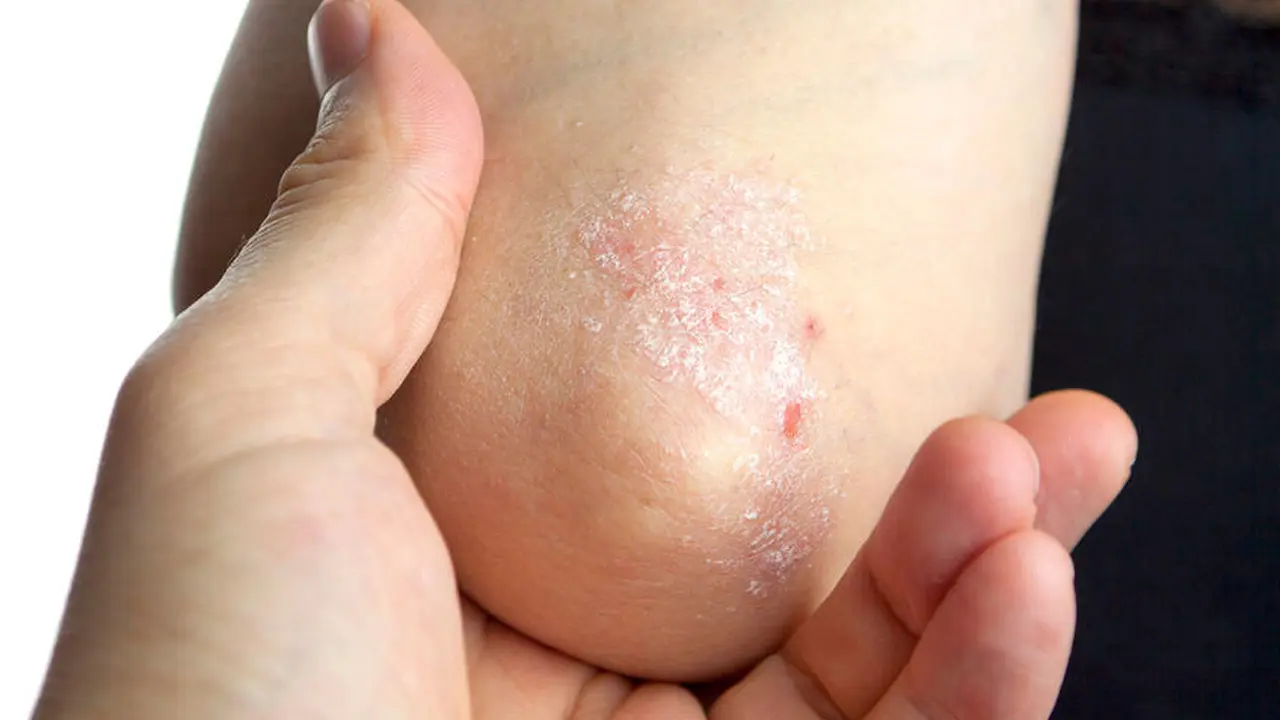 Psoriasis