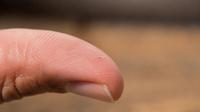 How to get splinter out with seven simple methods. (Image: Chat GPT)