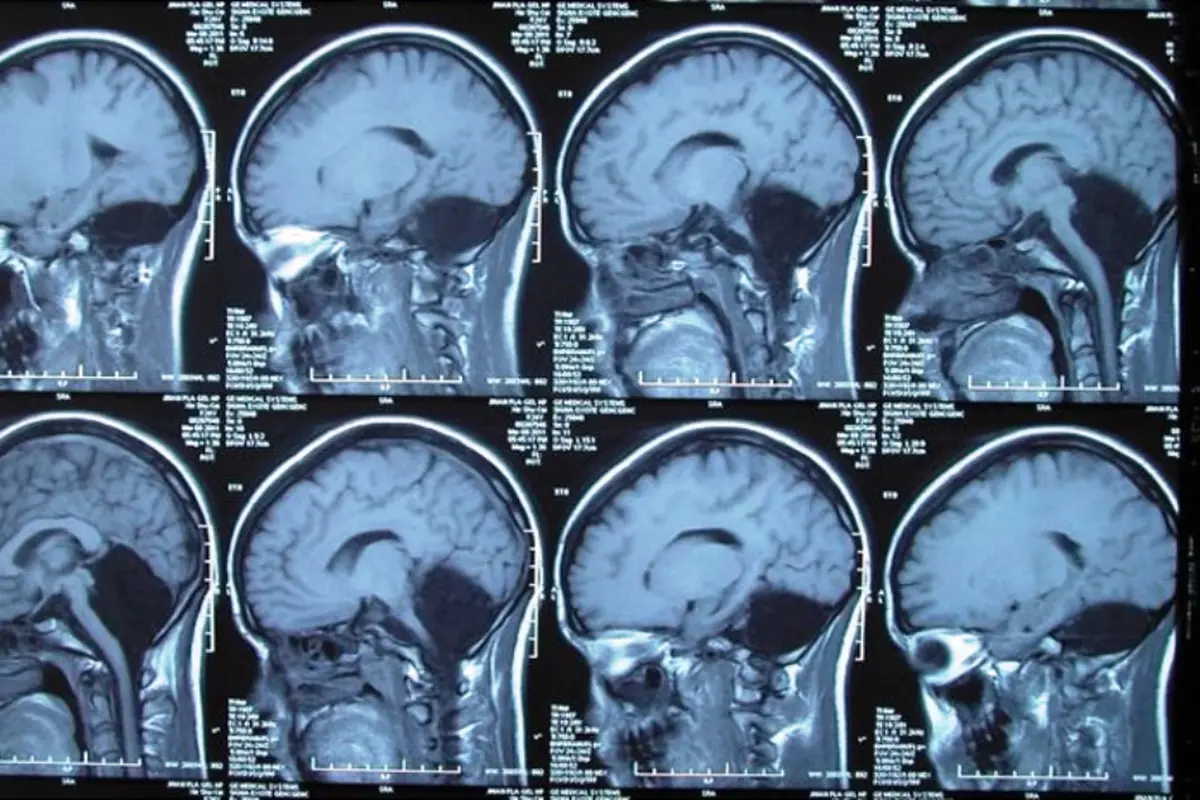 MRI pasien yang kehilangan otak kecil