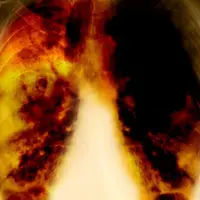 Menyerang penyanyi lawas January Christy, inilah gejala awal kanker paru-paru yang seringkali tak disadari oleh penderita. (Foto: diseasesweb.com)