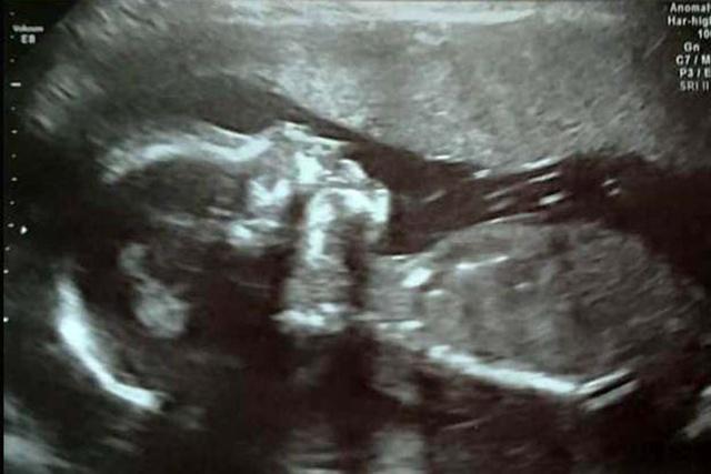 Hasil USG kehamilan Gemma | Photo: Copyright mirror.co.uk 