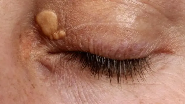 XAnthelasma. (foto: Pinterest/WobMD).