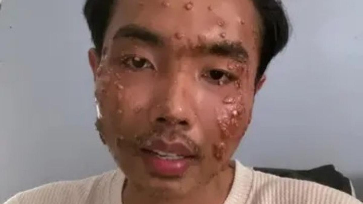 Waduh, TikToker Kena Penyakit Kulit Mengerikan karena Pakai Baju Bekas Tanpa Dicuci