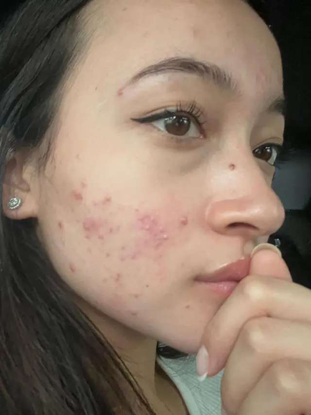 7 Potret Megan Domani Pamer Wajah Berjerawat, Sempat Takut Bertemu Orang Lain