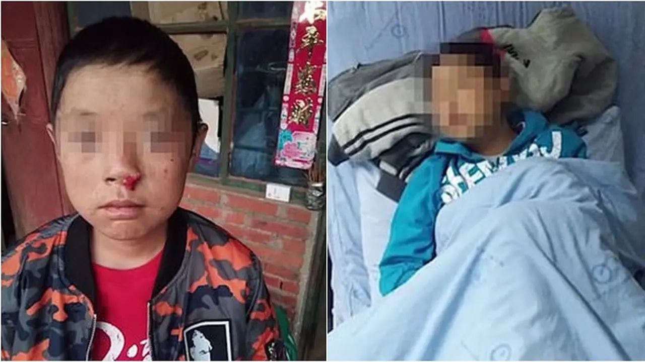 Bocah 12 Tahun Idap Penyakit Mirip Drakula, Bila Terkena Sinar Matahari