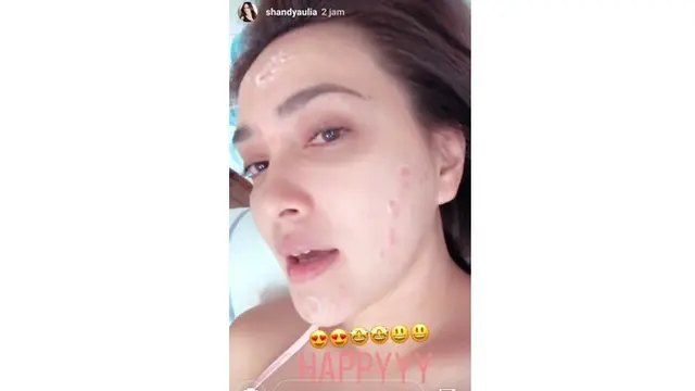 6 Seleb Ini Pernah Unggah Foto saat Wajah Berjerawat, Akui Tak Malu