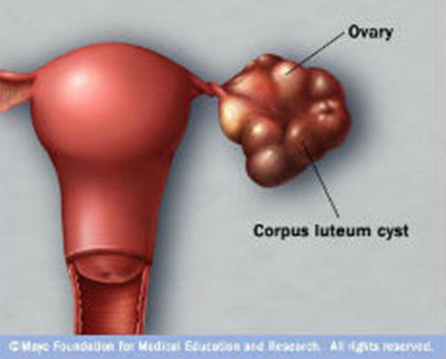 Korpus Luteum Kista | foto: copyright natural-fertility-info.com