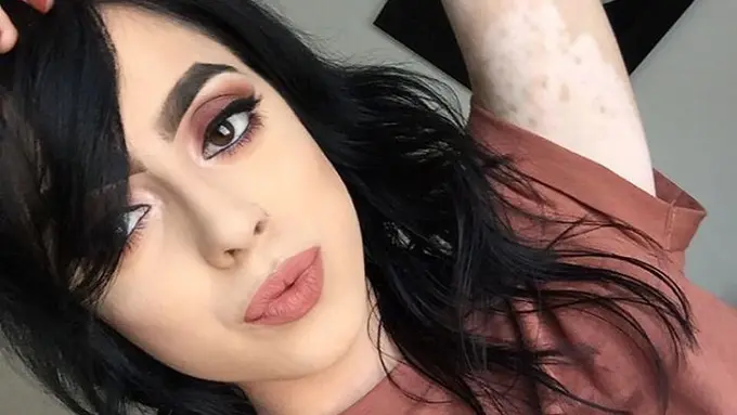 [Bintang] Alami Vitiligo, Wanita Ini Putuskan Tato Tubuh dengan Gambar Peta