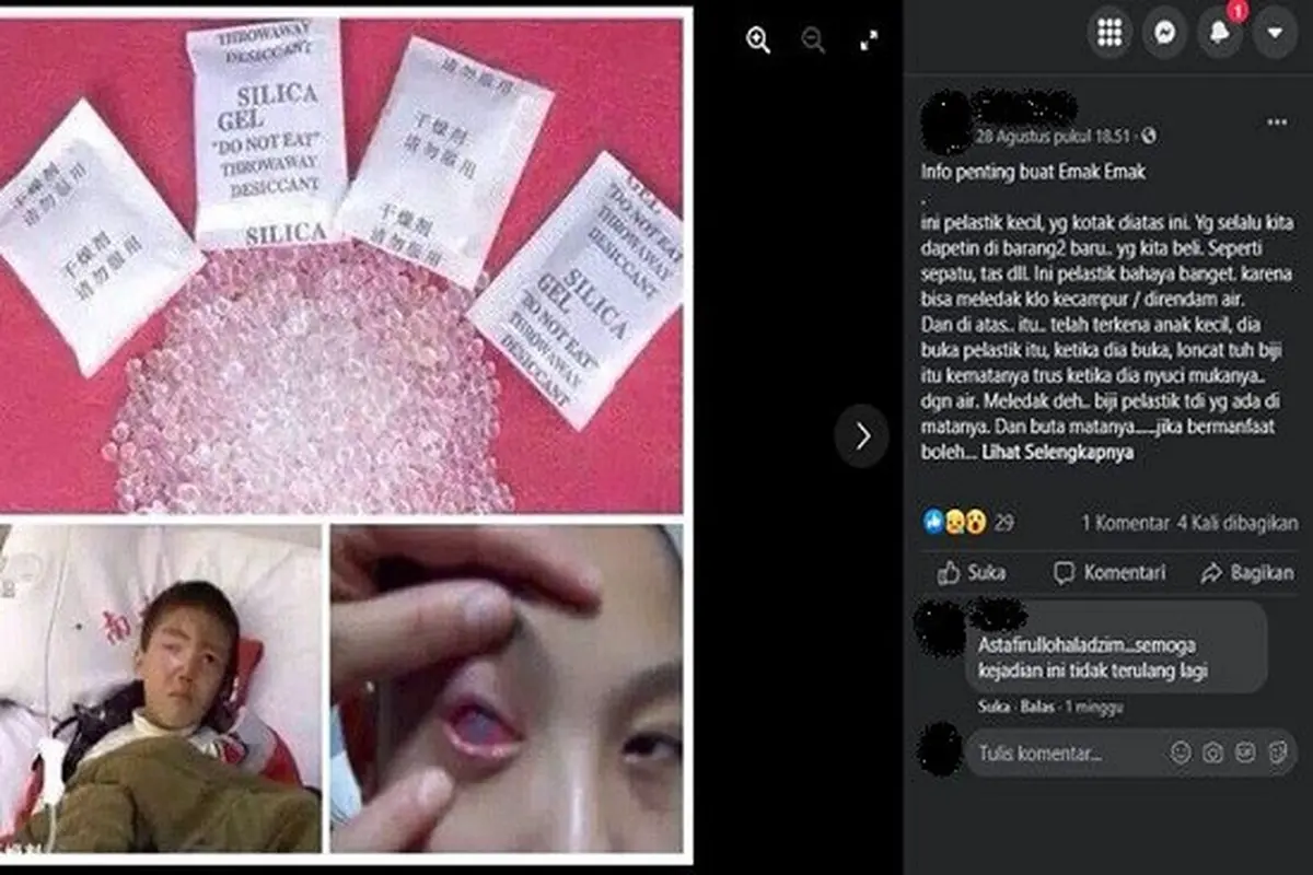 Gambar Tangkapan Layar Foto yang Diklaim Seorang Anak Buta karena Silica Gel Meledak di dalam Matanya (sumber: Facebook).