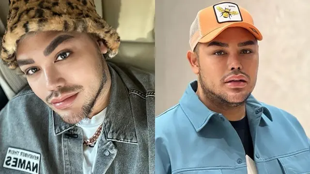 Beda Penampilan 9 Artis Sebelum vs Setelah Operasi Plastik, Bikin Pangling