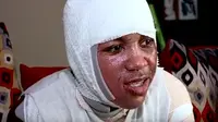 Tantangan Siram Air Mendidih yang Viral di AS Makan Korban Remaja 15 Tahun