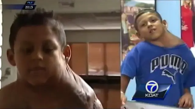 Tumor
