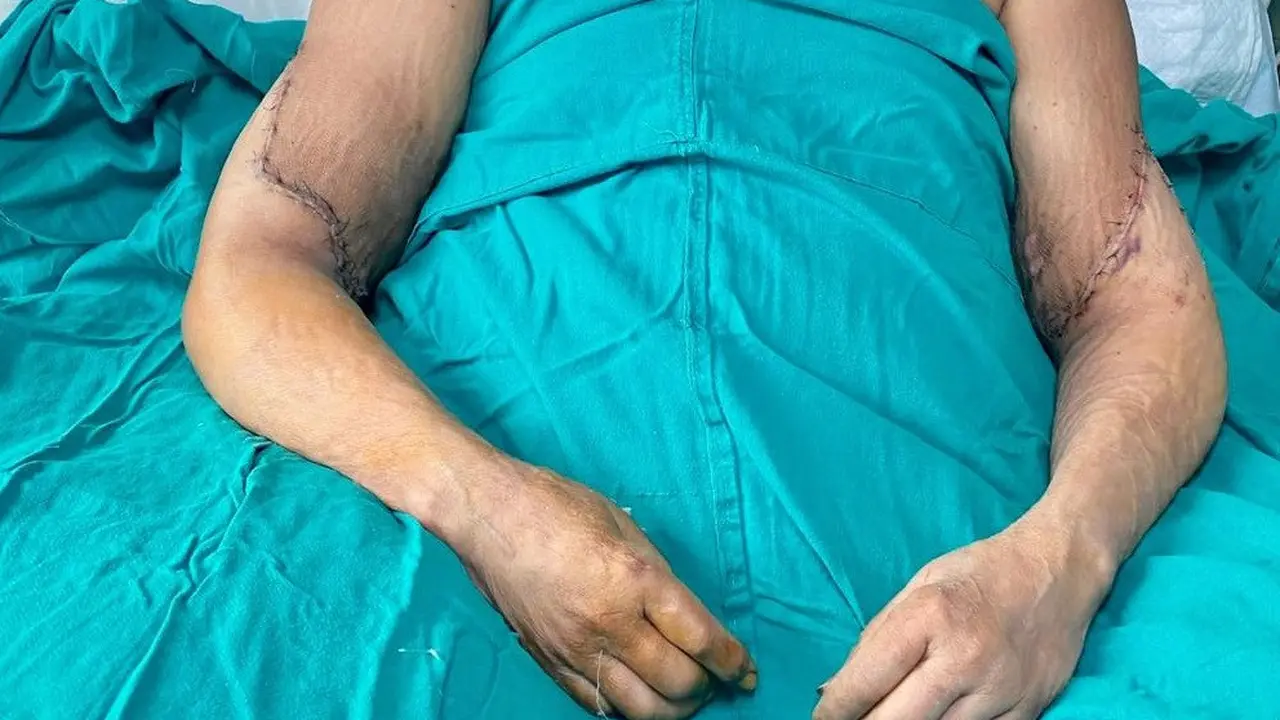 Transplantasi Dua Tangan