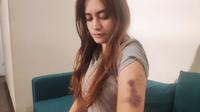 Korban peganiayaan oleh Polwan Polda Riau yang diperbantukan ke BNN Riau memperlihatkan bekas penganiayaan di lengannya.. (Liputan6.com/M Syukur)