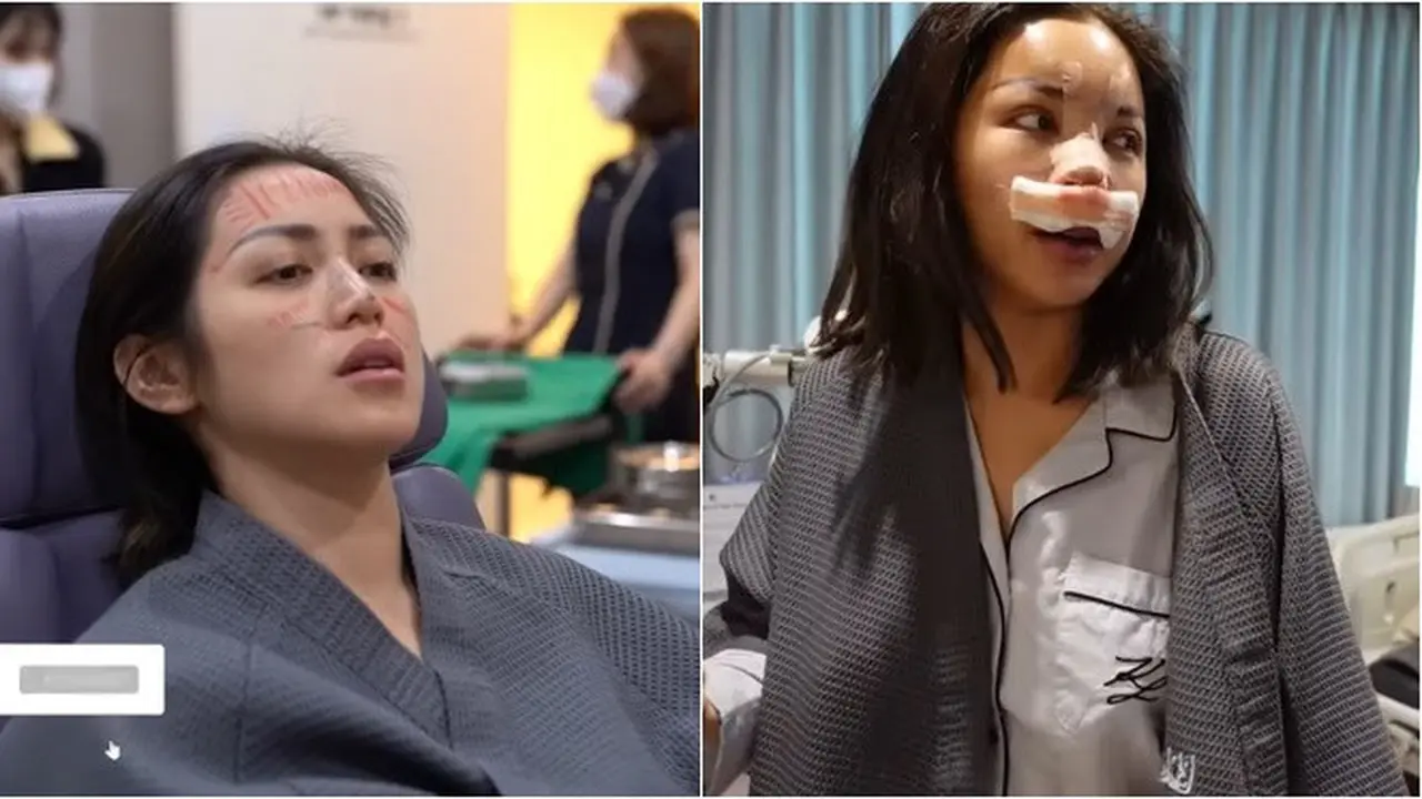 8 Potret Proses Jessica Iskandar Jalani Operasi Hidung di Korea, Bikin Pangling