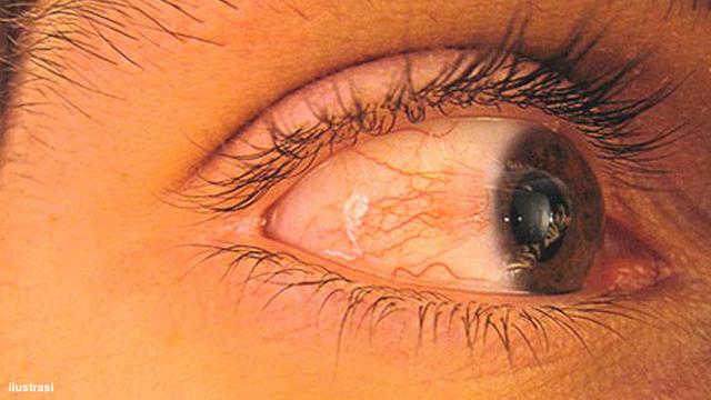 5 Penyebab Mata Bintitan Terus Menerus dan Cara Mengatasinya