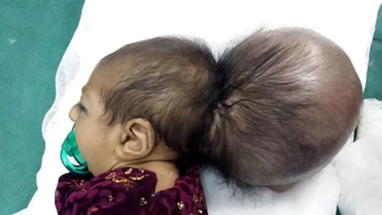 bayi-berkepala-dua-130925c.jpg