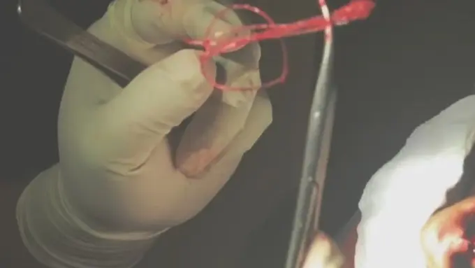 [Bintang] Berminat Tanam Benang? Coba Lihat Dulu Video yang Diunggah Oleh Dr Tompi Ini, Bikin Ngilu