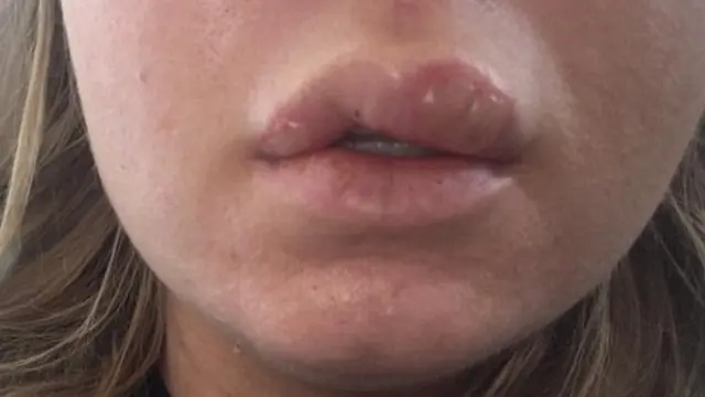 Akibat Gunakan Kosmetik Tiruan, Bibir Wanita Ini Bengkak Parah