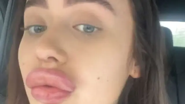 Lakukan Suntik Filler dengan Harga Murah, Bibir Wanita Ini Malah Bengkak Seperti Mau Meletus