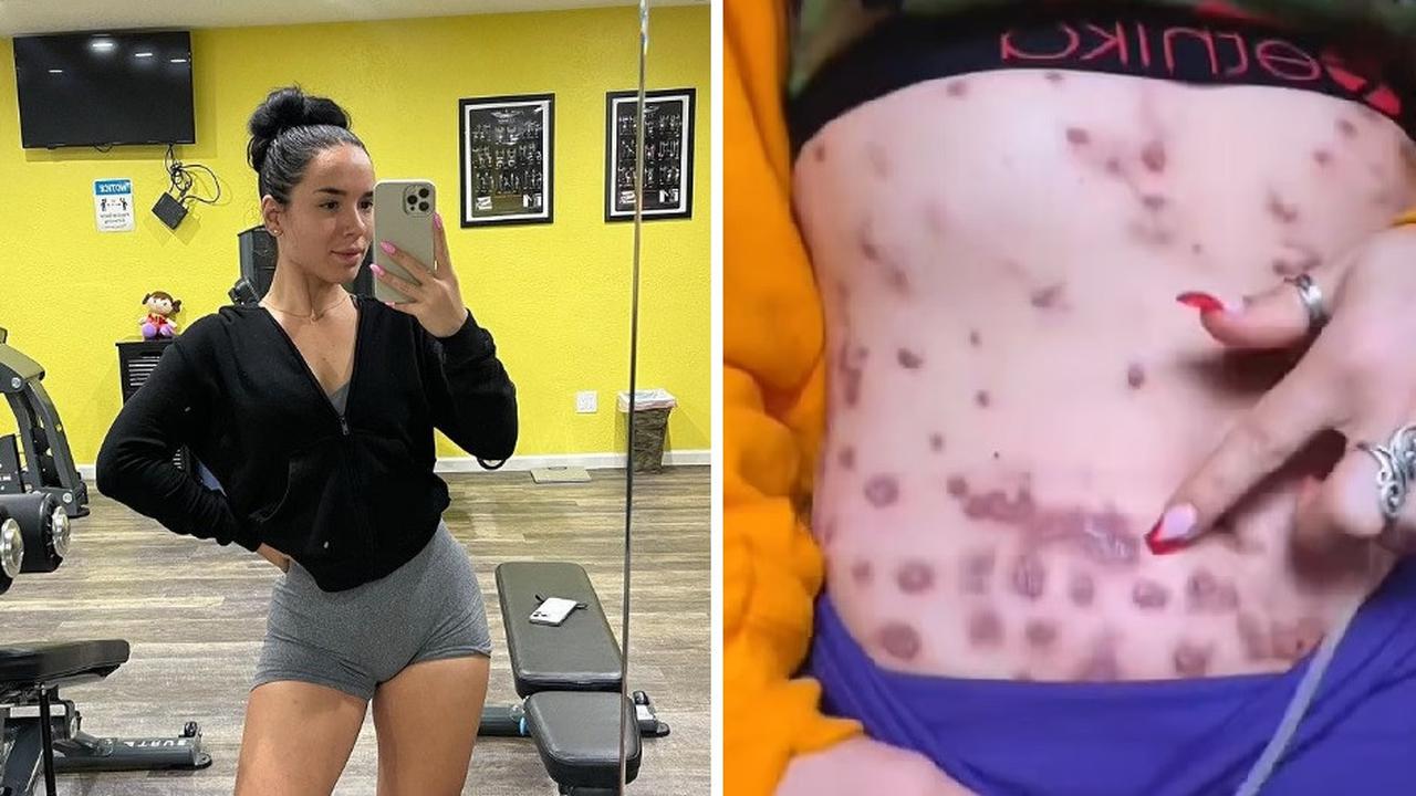 Tubuh Influencer Berakhir Digerogoti Penyakit Karena Suntikan Pembakar Lemak