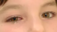 Radang mata sangat berisiko bagi kesehatan mata, apalagi jika peradangan ini terjadi pada si kecil. Kenali Pinkeye lebih jauh.